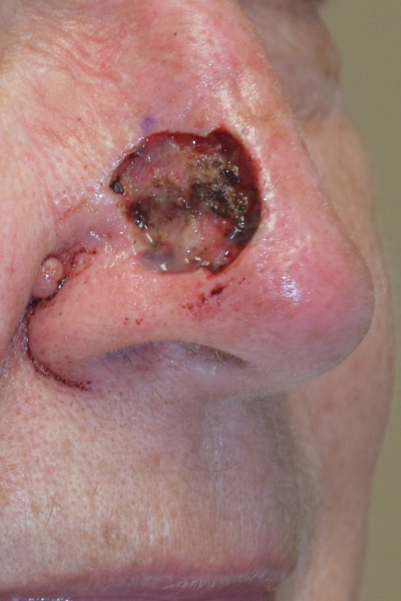 Skin Reconstruction Before & After Gallery - Patient 36550477 - Image 1