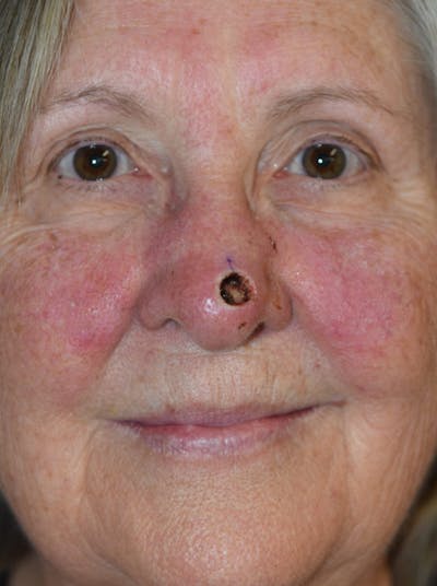 Skin Reconstruction Before & After Gallery - Patient 36550478 - Image 1