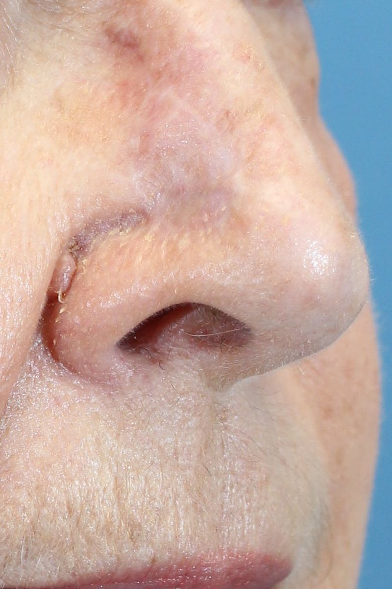 Skin Reconstruction Before & After Gallery - Patient 36550477 - Image 2