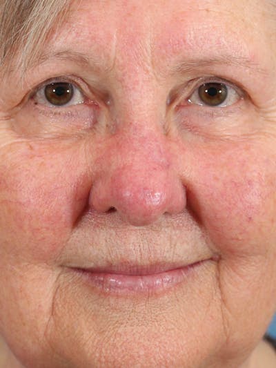 Skin Reconstruction Before & After Gallery - Patient 36550478 - Image 2