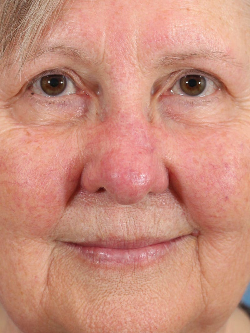 Skin Reconstruction Before & After Gallery - Patient 36550478 - Image 2