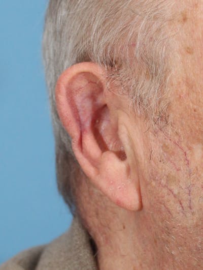 Skin Reconstruction Before & After Gallery - Patient 36550479 - Image 2