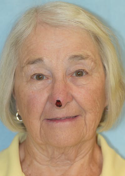 Skin Reconstruction Before & After Gallery - Patient 36550480 - Image 1