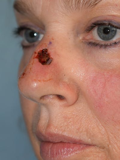 Skin Reconstruction Before & After Gallery - Patient 36550482 - Image 1
