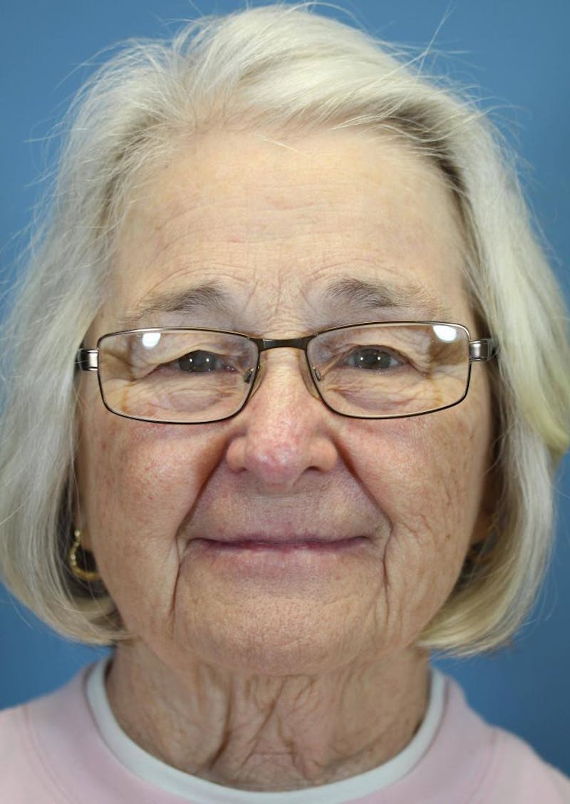 Skin Reconstruction Before & After Gallery - Patient 36550480 - Image 2