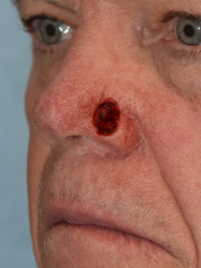 Skin Reconstruction Before & After Gallery - Patient 36550483 - Image 1