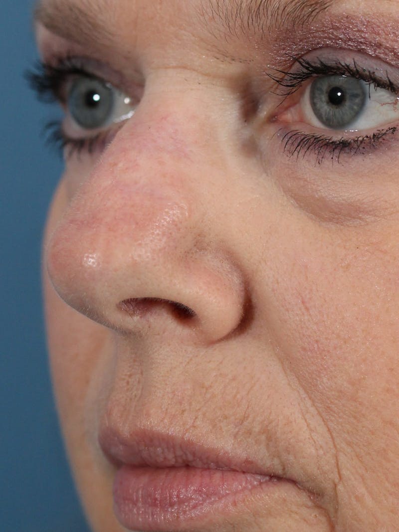 Skin Reconstruction Before & After Gallery - Patient 36550482 - Image 2