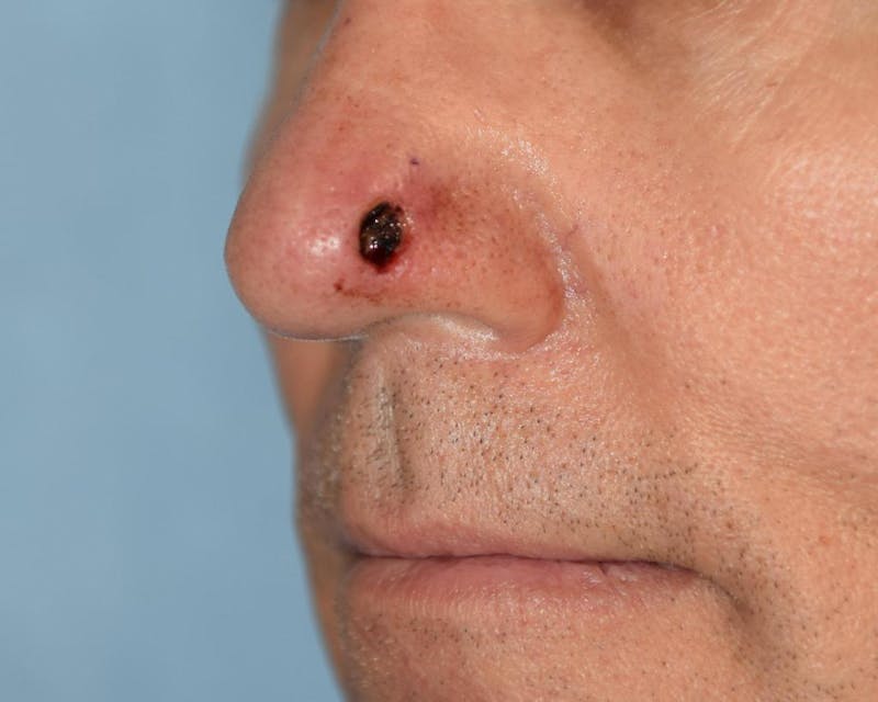 Skin Reconstruction Before & After Gallery - Patient 36550484 - Image 1