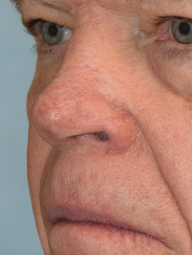 Skin Reconstruction Before & After Gallery - Patient 36550483 - Image 2