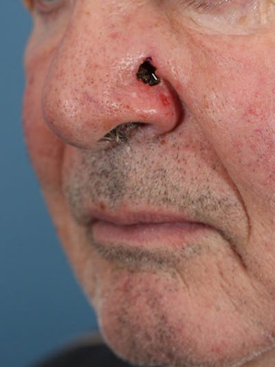 Skin Reconstruction Before & After Gallery - Patient 36550485 - Image 1