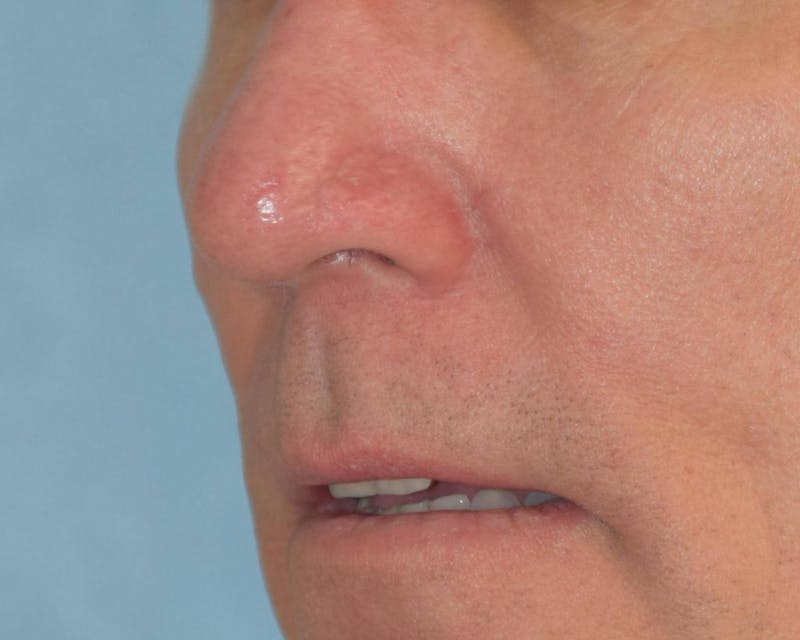 Skin Reconstruction Before & After Gallery - Patient 36550484 - Image 2