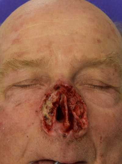 Skin Reconstruction Before & After Gallery - Patient 36550486 - Image 1