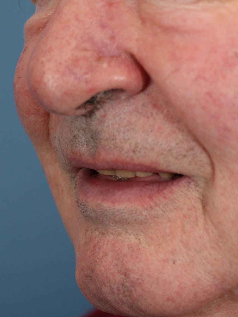 Skin Reconstruction Before & After Gallery - Patient 36550485 - Image 2