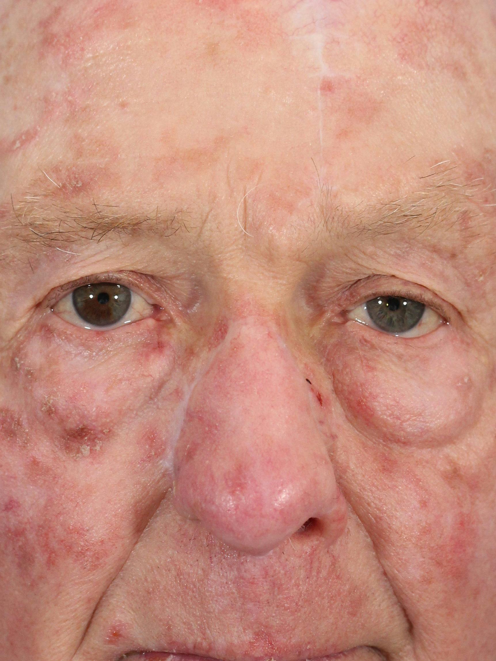 Skin Reconstruction Gallery - Patient 36550486 - Image 2