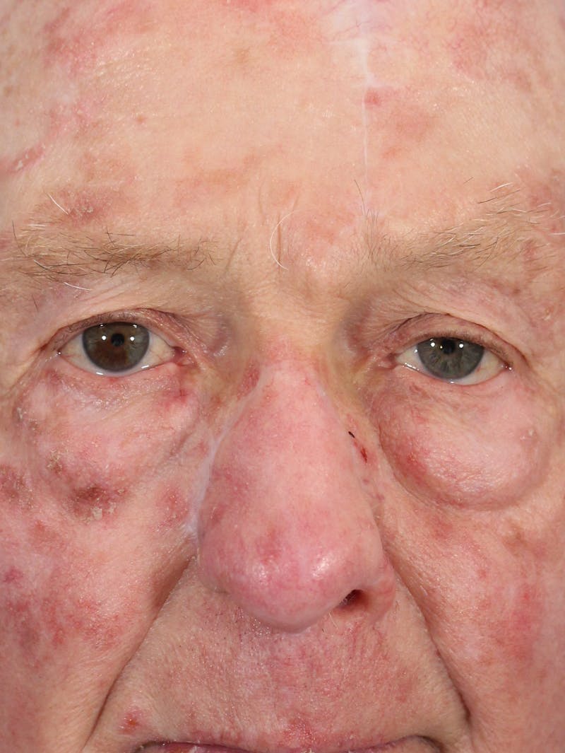 Skin Reconstruction Before & After Gallery - Patient 36550486 - Image 2
