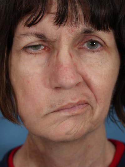 Facial Paralysis Before & After Gallery - Patient 36550521 - Image 1