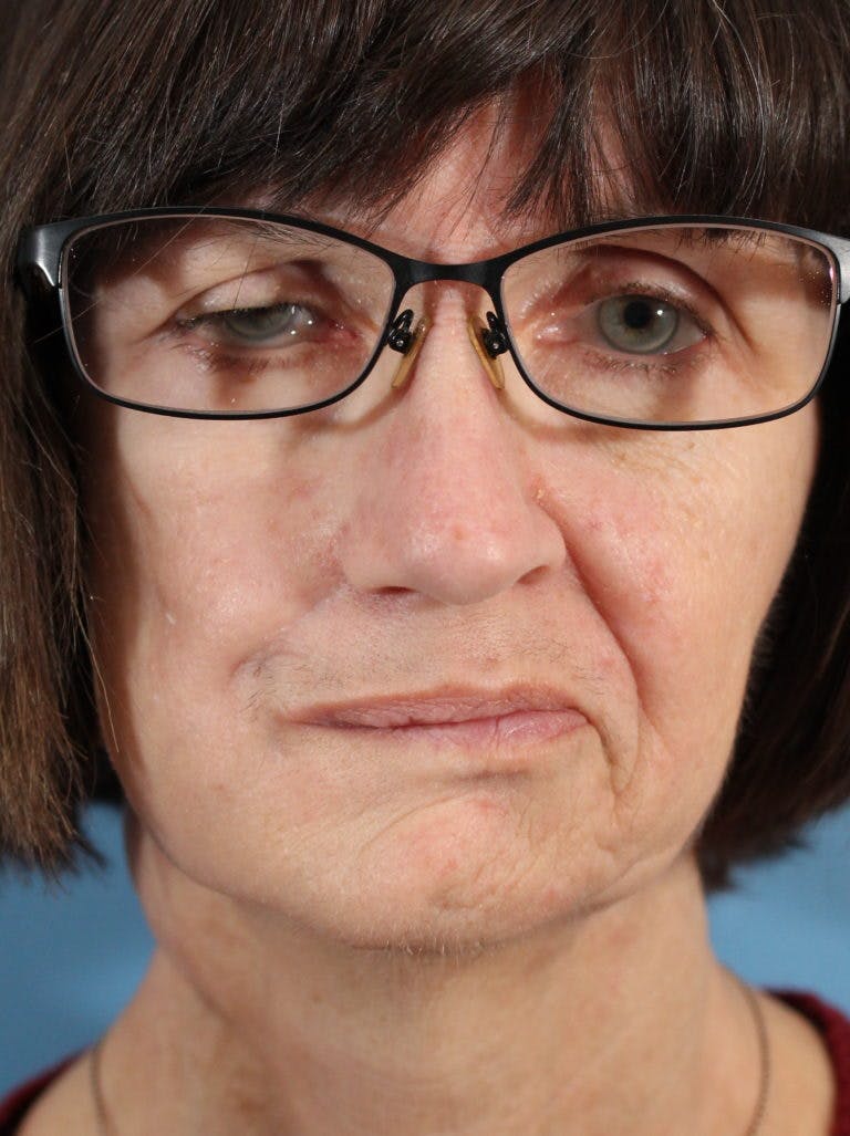 Facial Paralysis Before & After Photos Frankel Facial Plastic Surgery