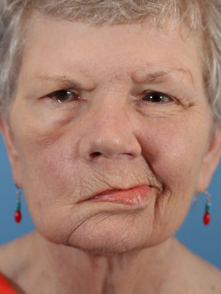 Facial Paralysis Gallery - Patient 36550522 - Image 1