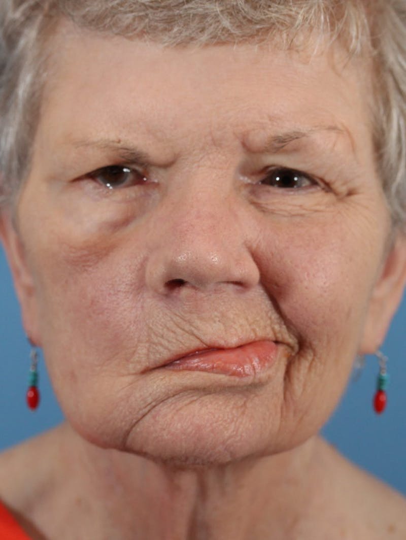Facial Paralysis Before & After Gallery - Patient 36550522 - Image 1