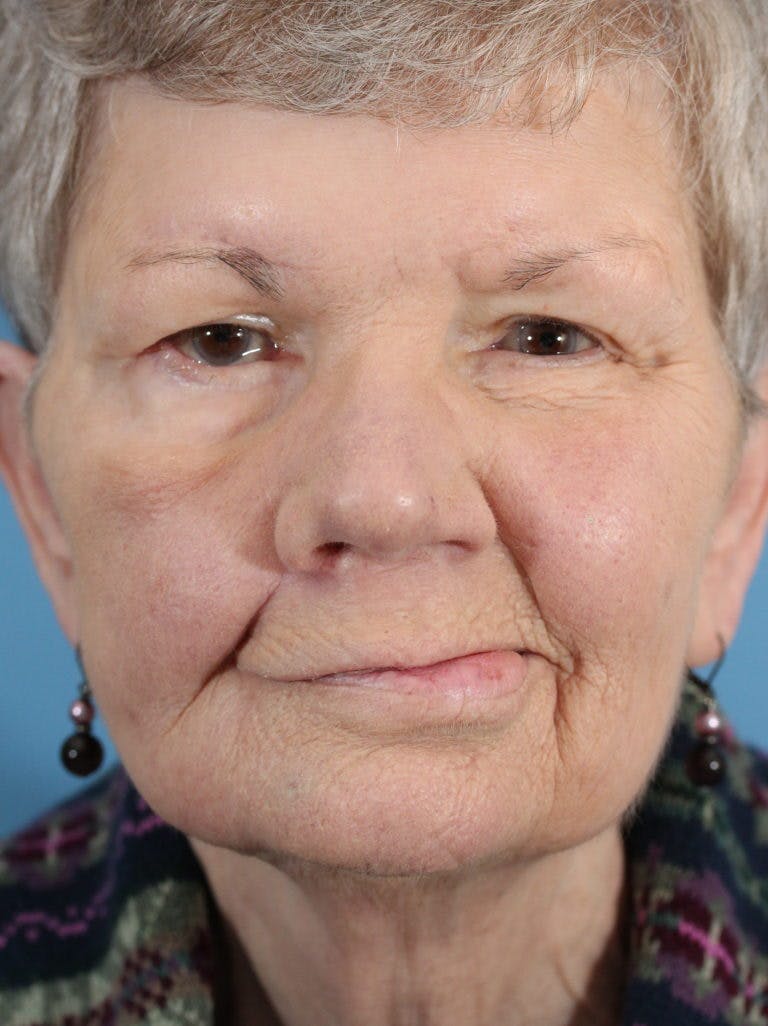 Facial Paralysis