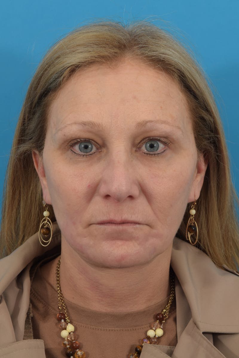 Facelift/Neck Lift Before & After Gallery - Patient 40544086 - Image 2