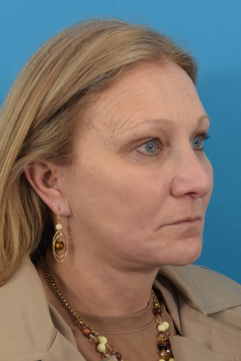 Facelift/Neck Lift Before & After Gallery - Patient 40544086 - Image 4