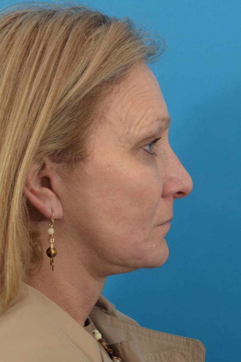 Facelift/Neck Lift Before & After Gallery - Patient 40544086 - Image 6