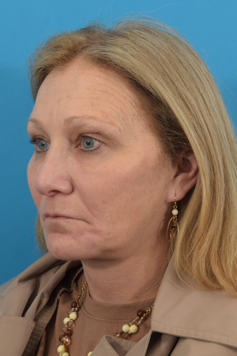 Facelift/Neck Lift Before & After Gallery - Patient 40544086 - Image 8
