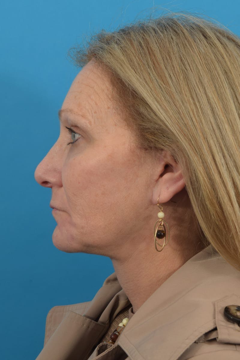 Blepharoplasty Before & After Gallery - Patient 57583679 - Image 10