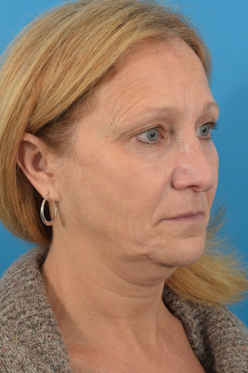 Blepharoplasty Before & After Gallery - Patient 57583679 - Image 3
