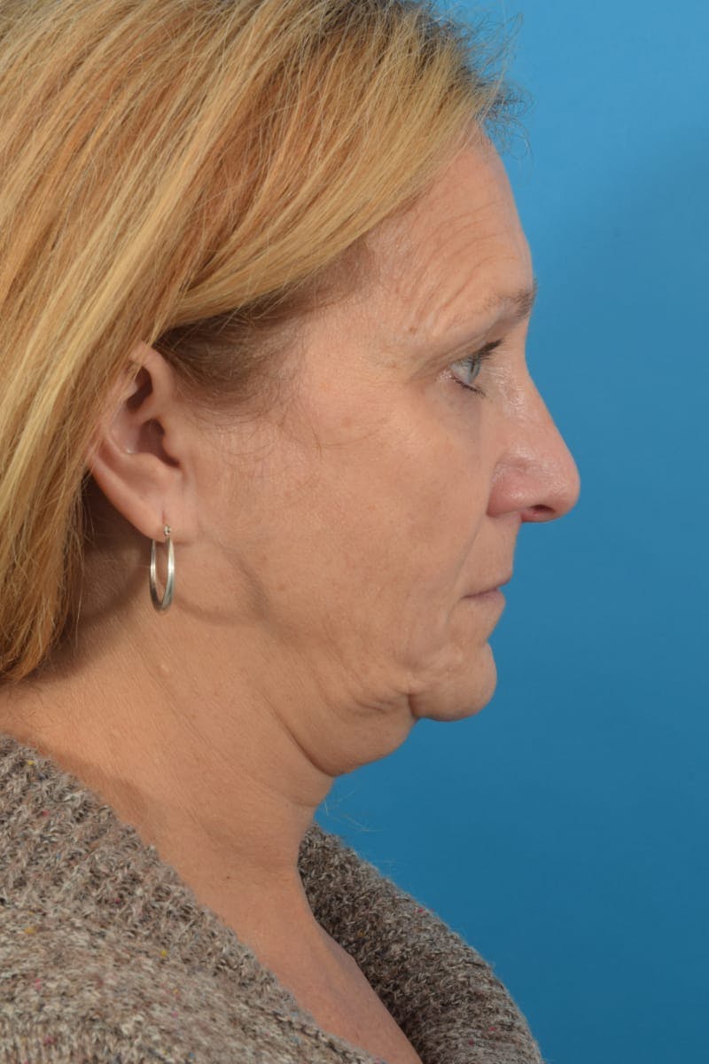 Facelift/Neck Lift Before & After Gallery - Patient 40544086 - Image 5