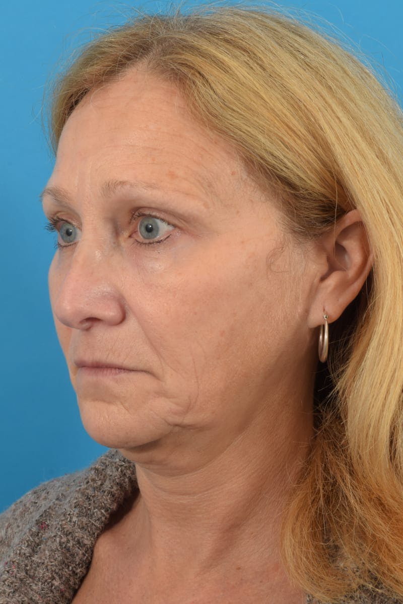 Laser Treatment Before & After Gallery - Patient 40544092 - Image 8