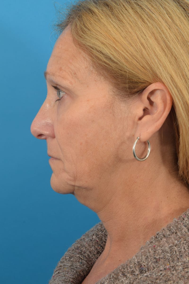 Facelift/Neck Lift Before & After Gallery - Patient 40544086 - Image 9