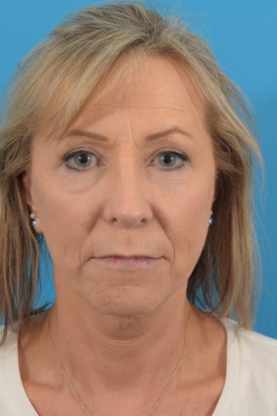 Facelift/Neck Lift Before & After Gallery - Patient 40544131 - Image 2