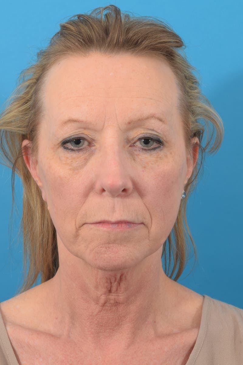 Blepharoplasty Before & After Gallery - Patient 57583680 - Image 1