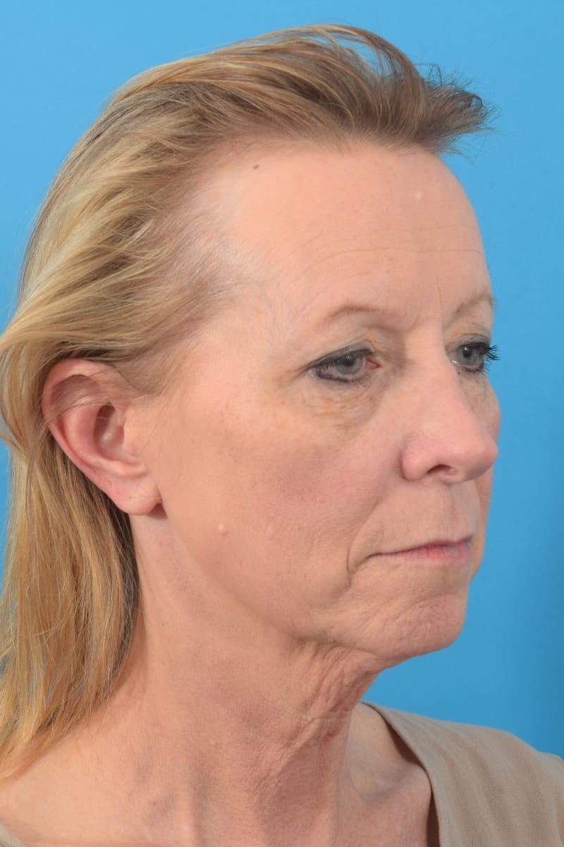 Blepharoplasty Before & After Gallery - Patient 57583680 - Image 5