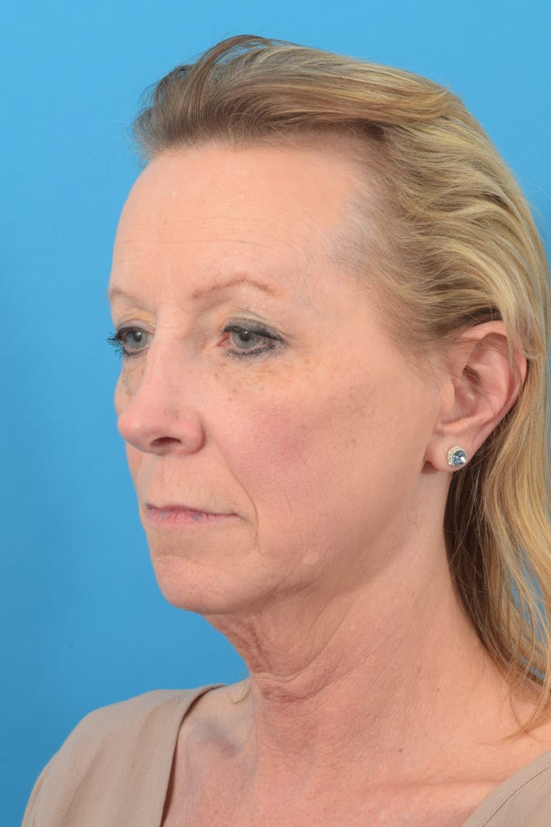 Blepharoplasty Before & After Gallery - Patient 57583680 - Image 3