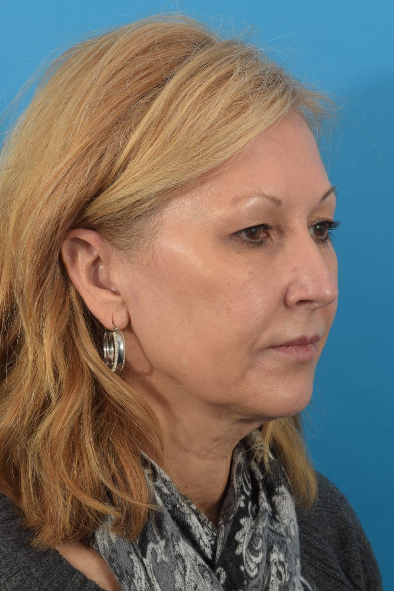 Laser Treatment Before & After Gallery - Patient 40749736 - Image 7