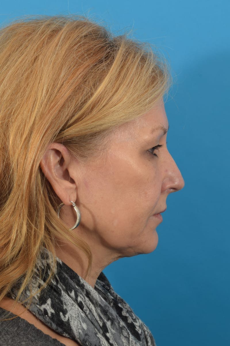 Laser Treatment Before & After Gallery - Patient 40749736 - Image 8