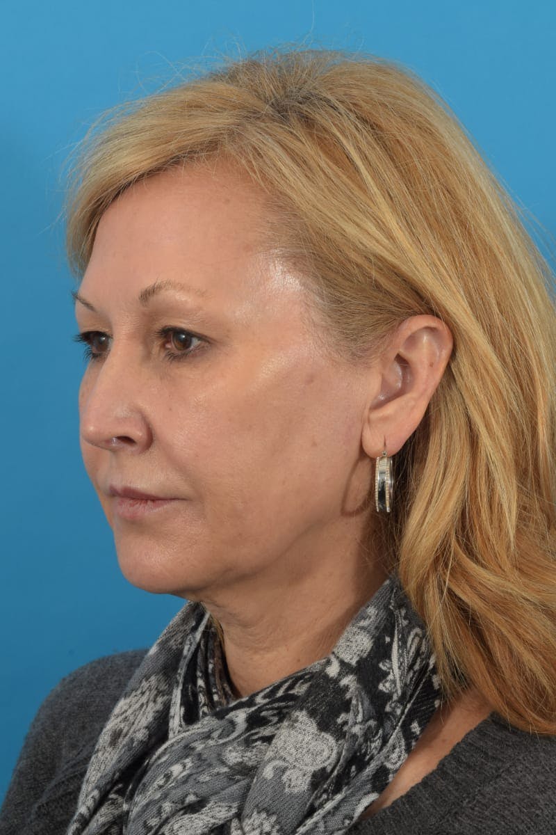 Laser Treatment Before & After Gallery - Patient 40749736 - Image 3