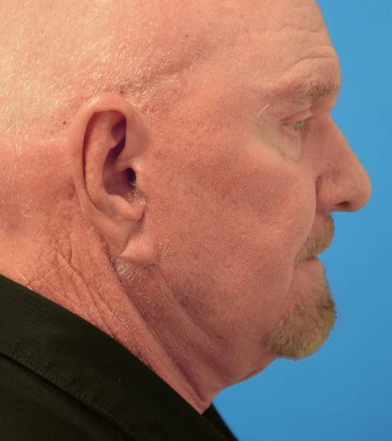 Blepharoplasty Before & After Gallery - Patient 36535139 - Image 1