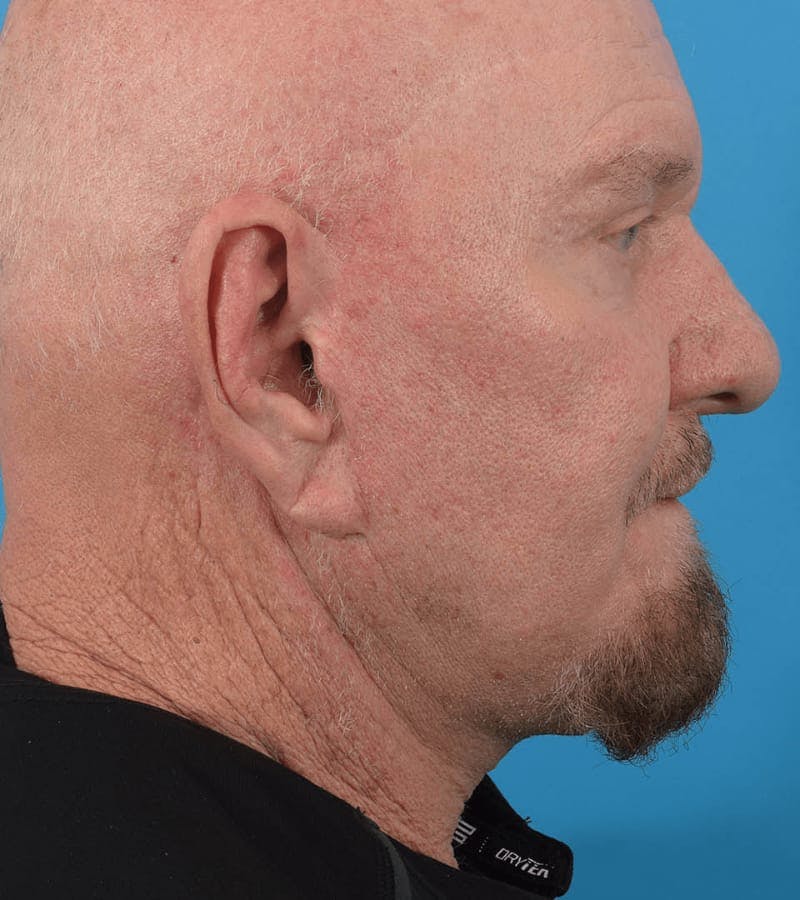 Blepharoplasty Before & After Gallery - Patient 36535139 - Image 2
