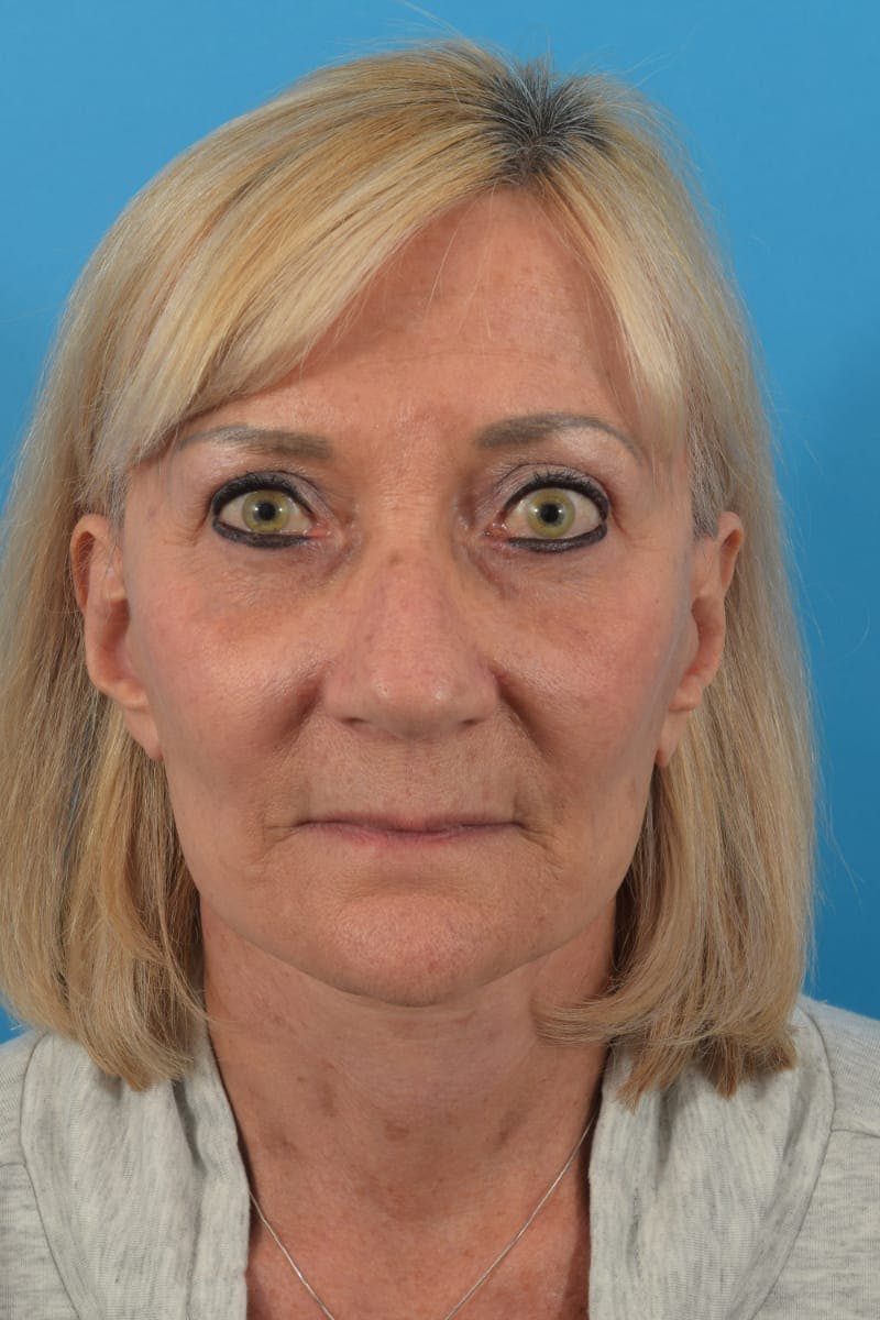 Blepharoplasty Before & After Gallery - Patient 36535141 - Image 2