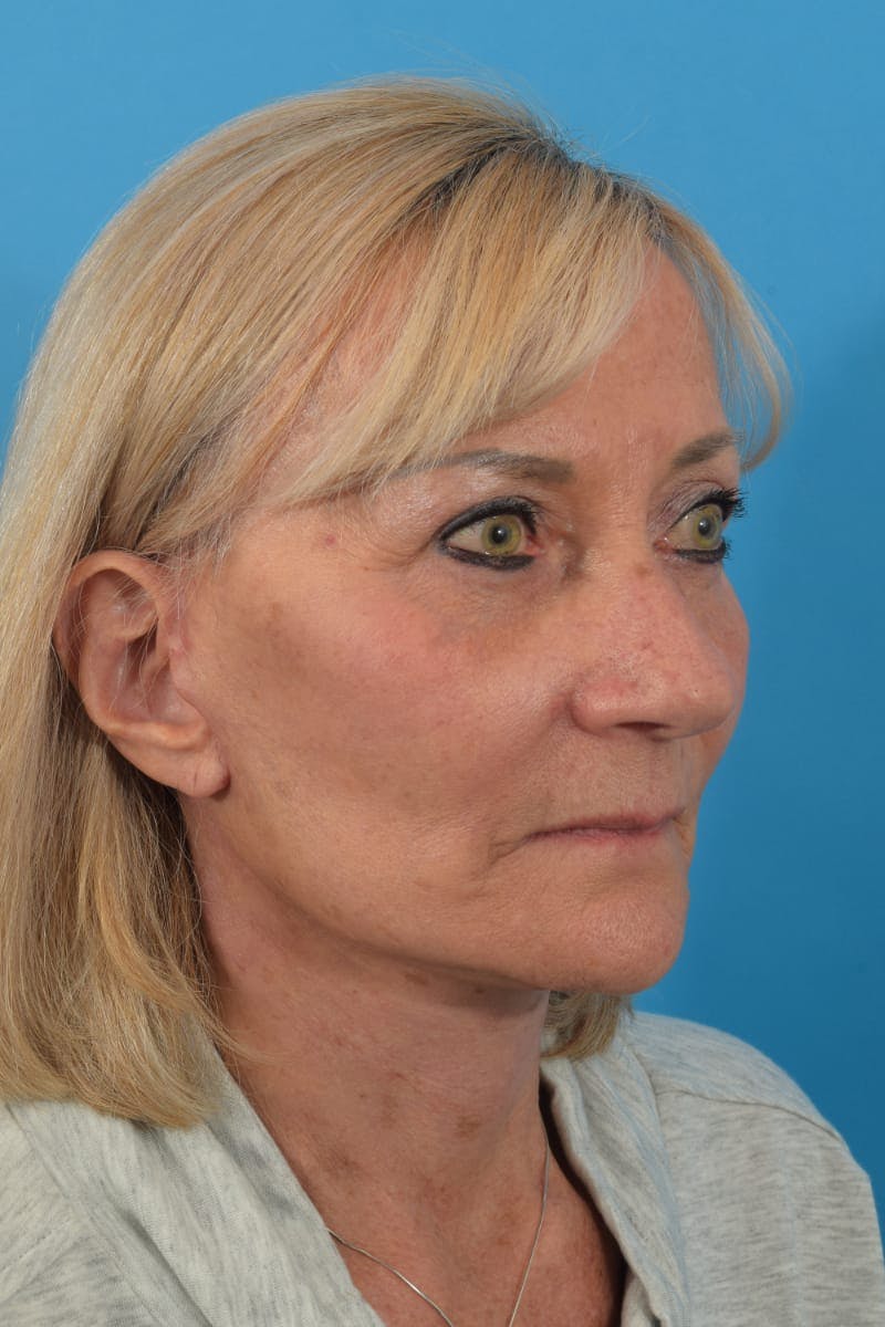 Blepharoplasty Before & After Gallery - Patient 36535141 - Image 4
