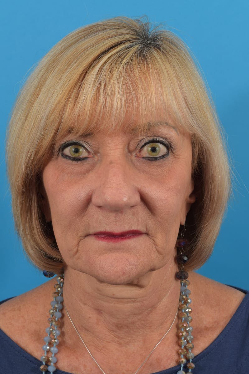 Blepharoplasty Before & After Gallery - Patient 36535141 - Image 1