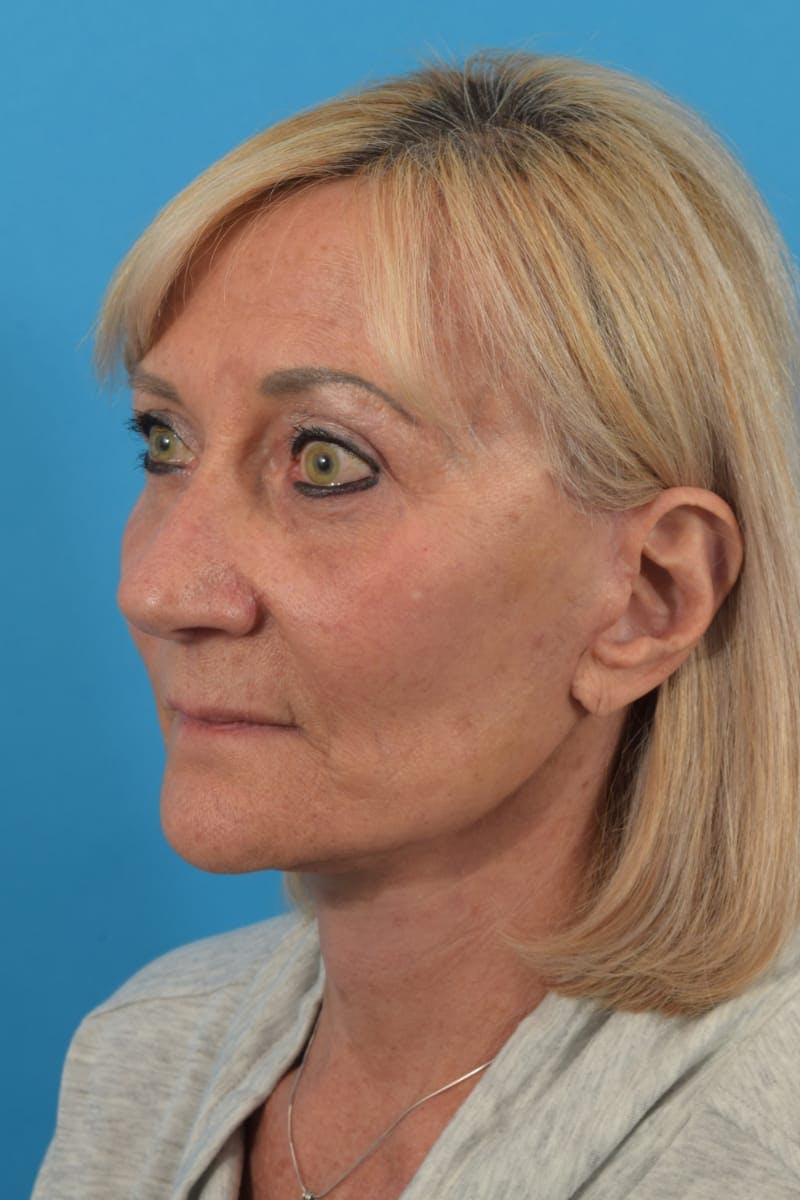 Blepharoplasty Before & After Gallery - Patient 36535141 - Image 6