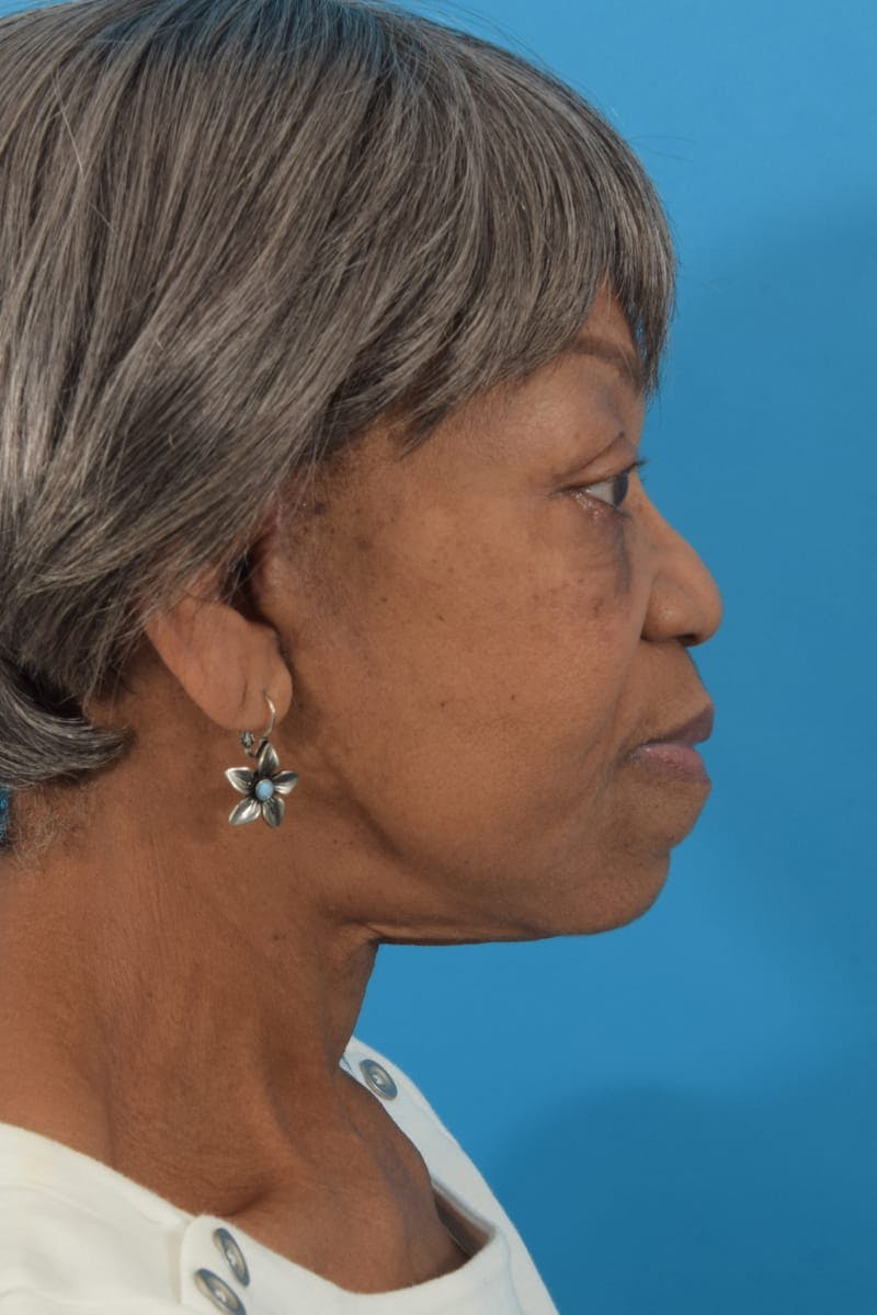 Facelift/Neck Lift Before & After Gallery - Patient 40544459 - Image 6