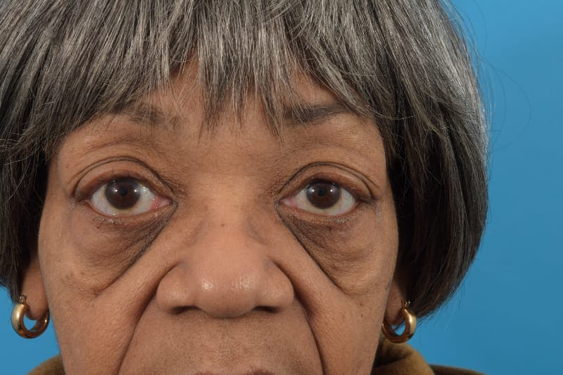 Blepharoplasty Before & After Gallery - Patient 57583682 - Image 9