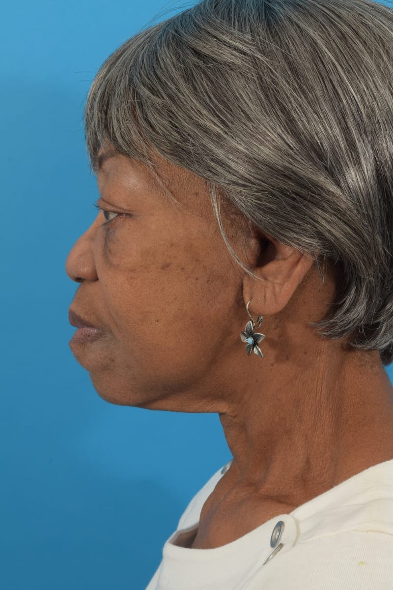 Facelift/Neck Lift Before & After Gallery - Patient 40544459 - Image 8