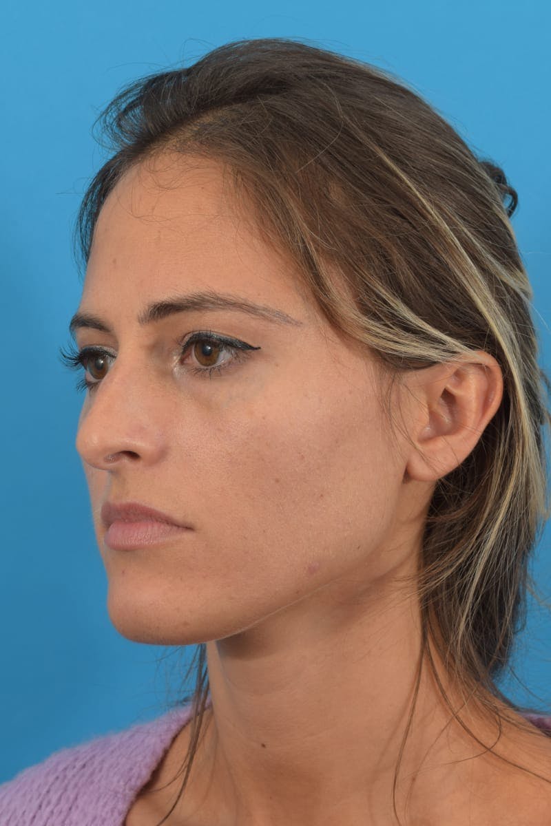Blepharoplasty Before & After Gallery - Patient 40544526 - Image 5